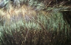 Lice Eggs In Hair Egg For Hair Lice Eggs Louse